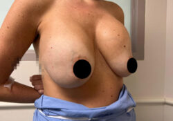 Breast Augmentation