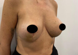 Breast Augmentation