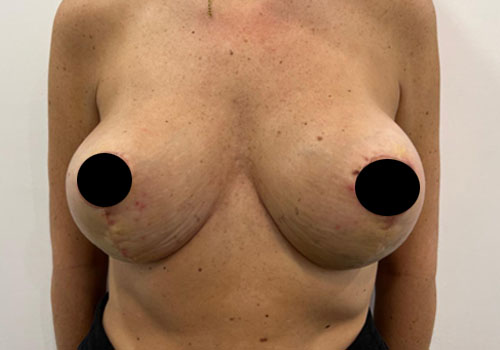 Breast Augmentation