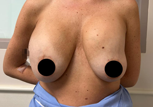 Breast Lift