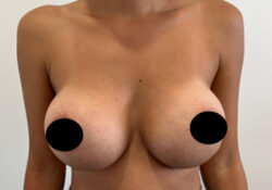 Breast Augmentation