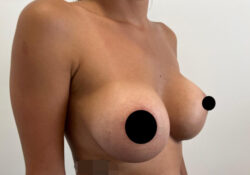 Breast Augmentation