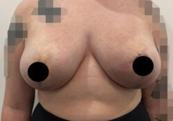 Breast Reduction