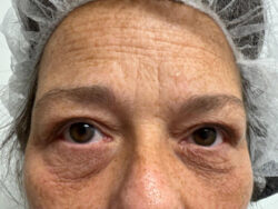 Eyelid Surgery