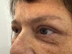 Eyelid Surgery