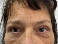 Eyelid Surgery