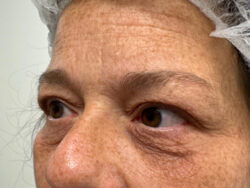 Eyelid Surgery