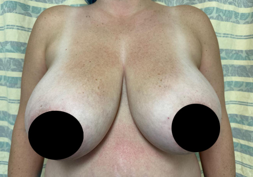 Breast Reduction