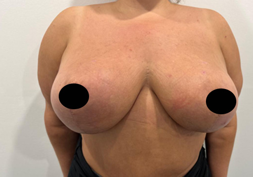 Breast Reduction Case 22011 After Photo Breast Reduction