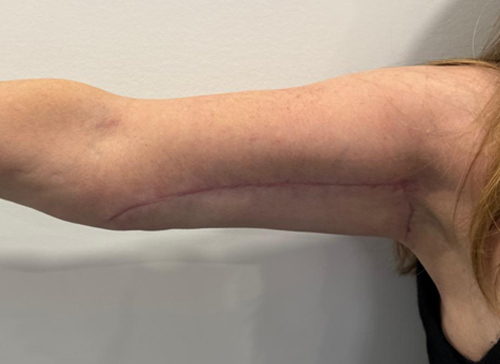 Arm Lift Case 22016 After Photo Arm Lift