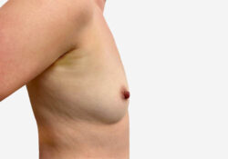 Breast Augmentation