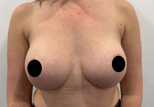 Breast Augmentation