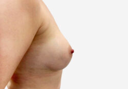 Breast Augmentation