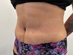 Tummy Tuck