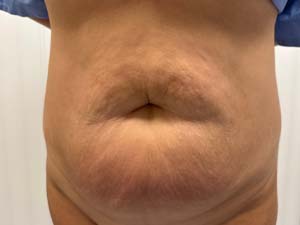 Tummy Tuck