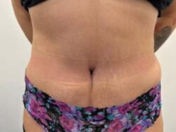 Tummy Tuck