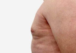 Male Breast Reduction