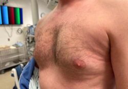 Male Breast Reduction