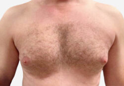 Male Breast Reduction