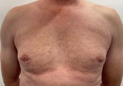 Male Breast Reduction