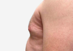 Male Breast Reduction