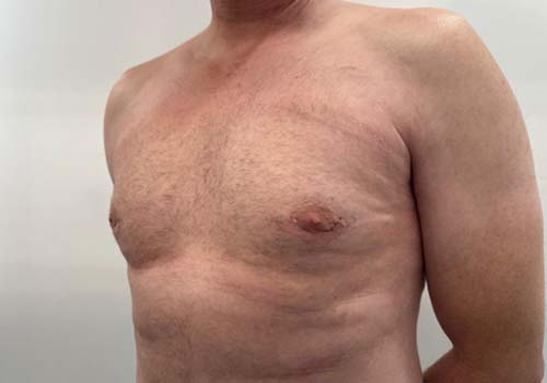 Male Breast Reduction