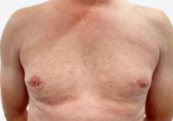 Male Breast Reduction