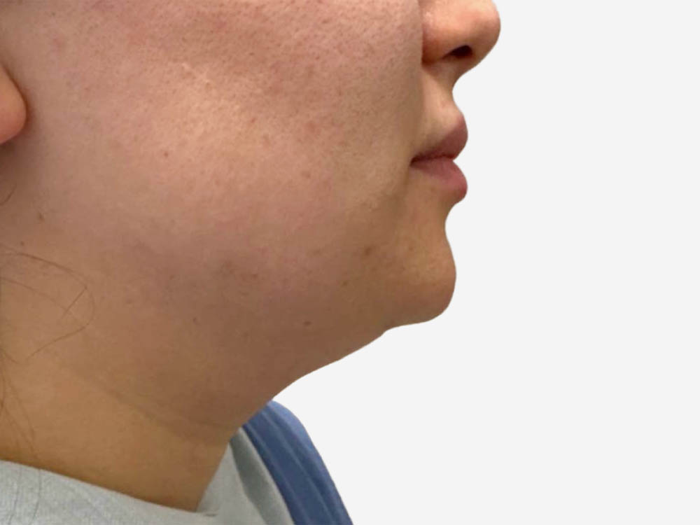 Neck & Chin Liposuction