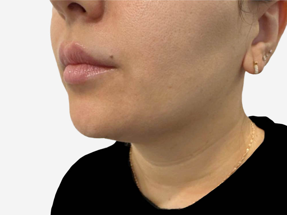 Neck & Chin Liposuction