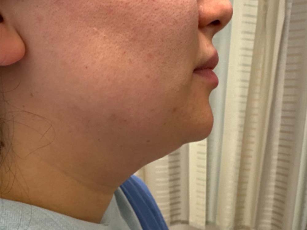 Neck & Chin Liposuction