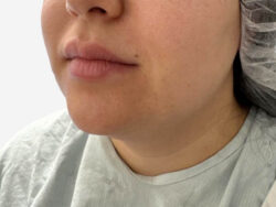 Neck & Chin Liposuction
