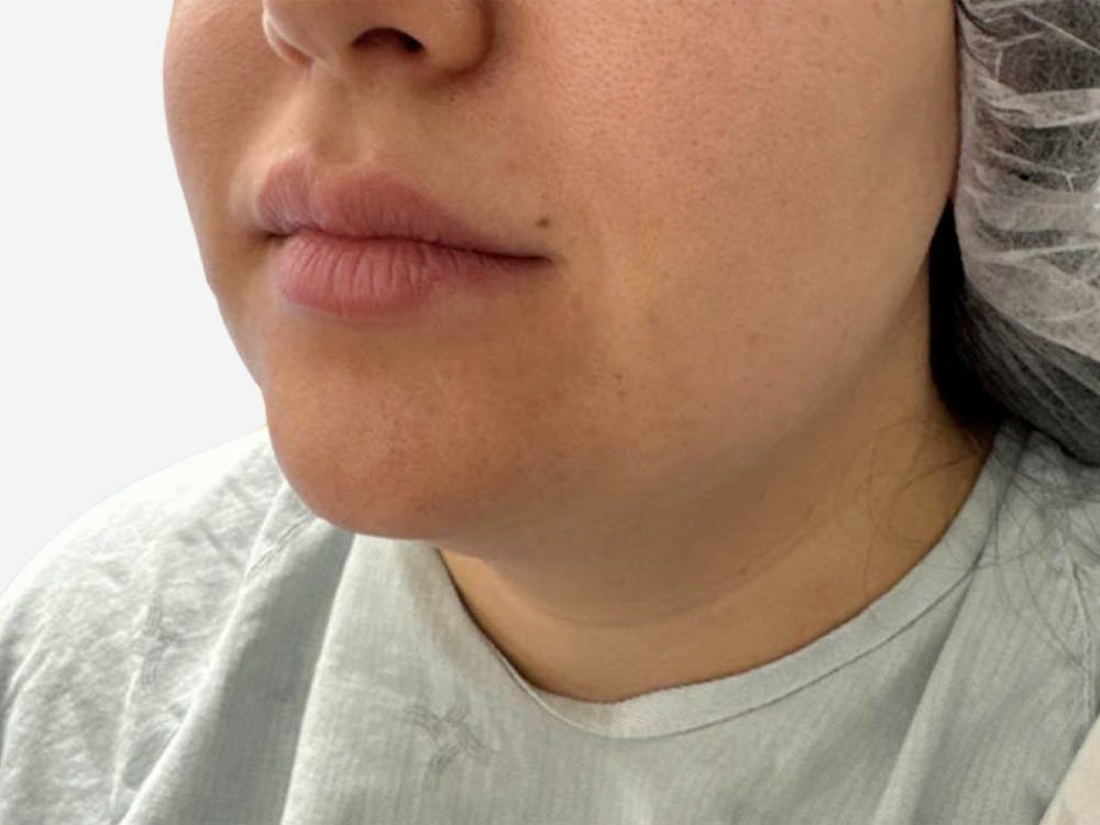 Neck & Chin Liposuction