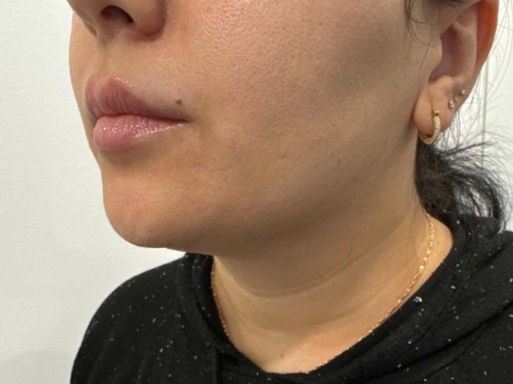 Neck & Chin Liposuction