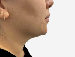 Neck & Chin Liposuction