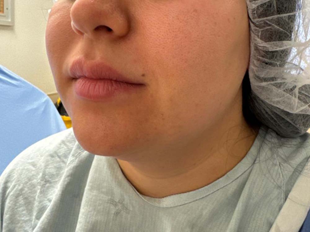 Neck & Chin Liposuction