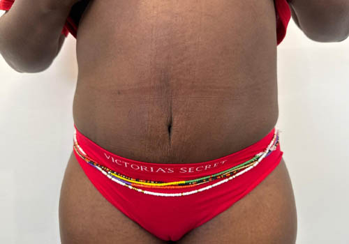 Tummy Tuck