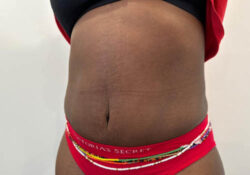 Tummy Tuck