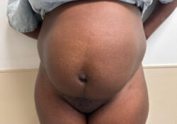 Tummy Tuck