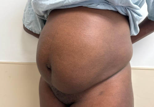 Tummy Tuck