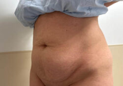 Tummy Tuck
