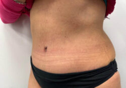 Tummy Tuck