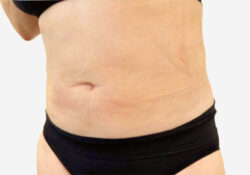 Liposuction