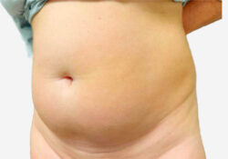 Liposuction