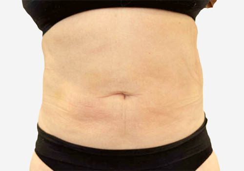 Liposuction