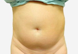 Liposuction