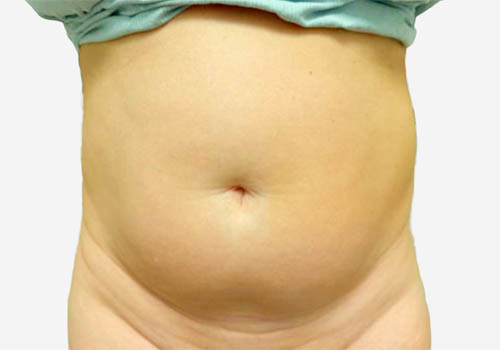 Liposuction