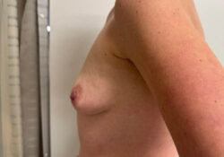 Breast Lift