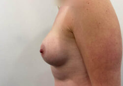 Breast Lift