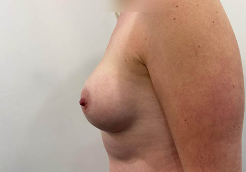 Breast Lift