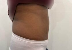 Tummy Tuck